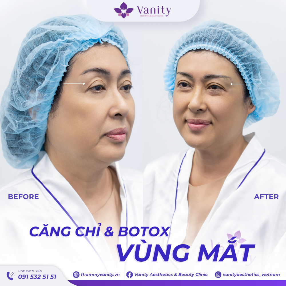 CĂNG CHỈ & BOTOX VÙNG MẮT